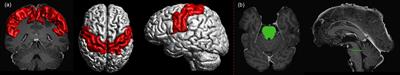 Tracking the Corticospinal Tract in Patients With High-Grade Glioma: Clinical Evaluation of Multi-Level Fiber Tracking and Comparison to Conventional Deterministic Approaches